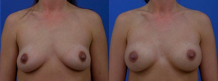 Breast Augmentation Before & After Gallery - Patient 122405429 - Image 1