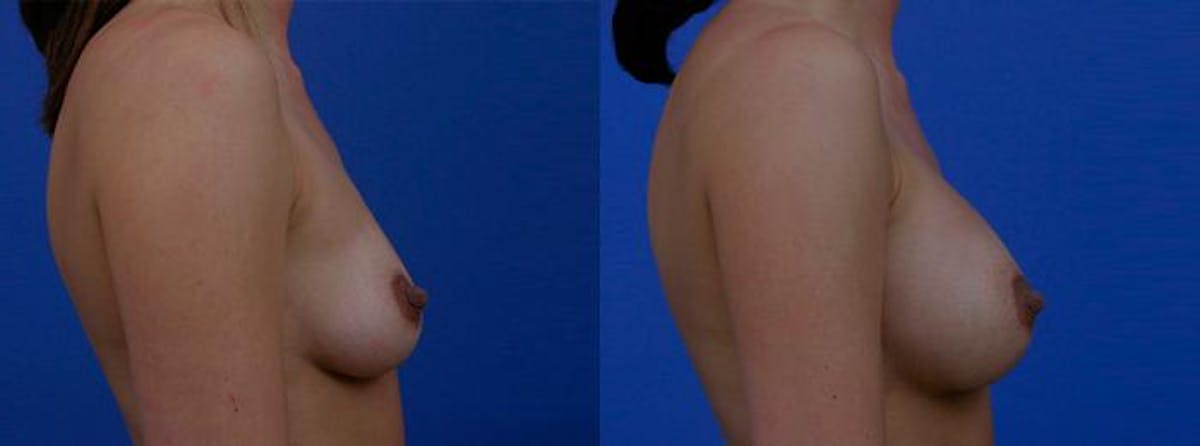 Breast Augmentation Before & After Gallery - Patient 685129 - Image 2