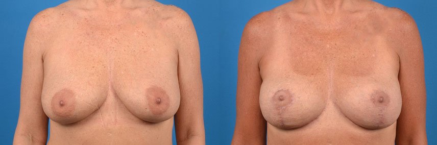 Hidden Breast Lift Before & After Gallery - Patient 303365 - Image 1