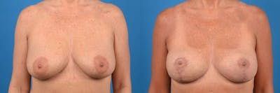 Breast Lift Before & After Gallery - Patient 304500 - Image 1