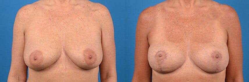 Breast Lift Before & After Gallery - Patient 122405431 - Image 1