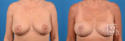 Hidden Breast Lift Before & After Gallery - Patient 303365 - Image 1