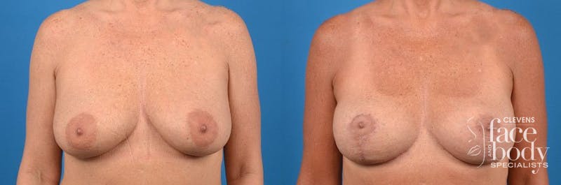 Hidden Breast Lift Before & After Gallery - Patient 410520 - Image 1
