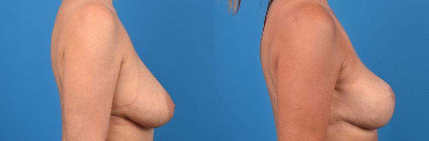 Hidden Breast Lift Before & After Gallery - Patient 303365 - Image 2