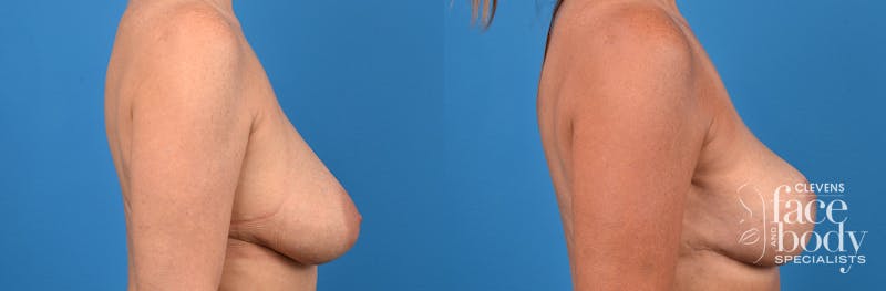 Hidden Breast Lift Before & After Gallery - Patient 410520 - Image 2