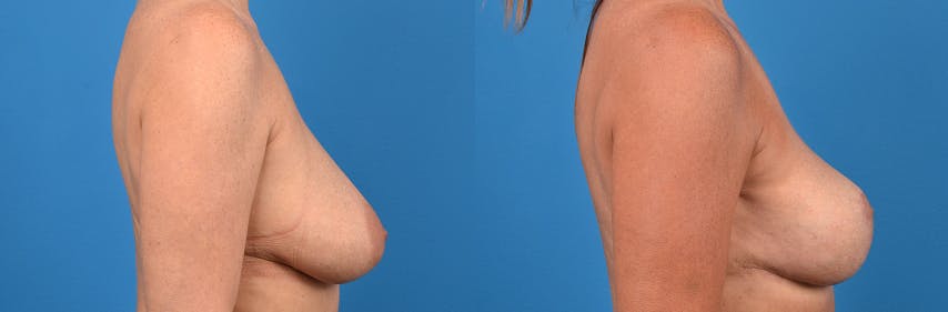 Breast Lift Before & After Gallery - Patient 122405431 - Image 2