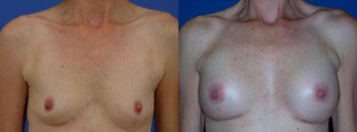 Hidden Breast Aug Before & After Gallery - Patient 323061 - Image 1