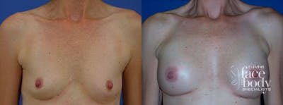 Hidden Breast Aug Before & After Gallery - Patient 323061 - Image 1
