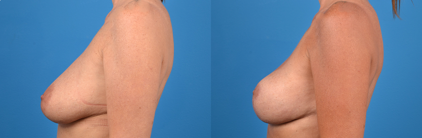 Hidden Breast Lift Before & After Gallery - Patient 410520 - Image 3