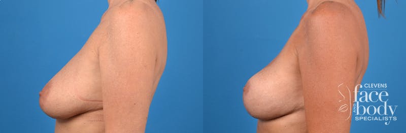 Hidden Breast Lift Before & After Gallery - Patient 410520 - Image 3