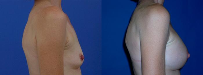 Hidden Breast Aug Before & After Gallery - Patient 323061 - Image 2