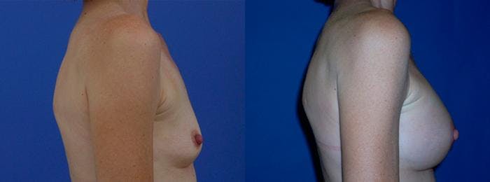 Breast Augmentation Before & After Gallery - Patient 122405430 - Image 2