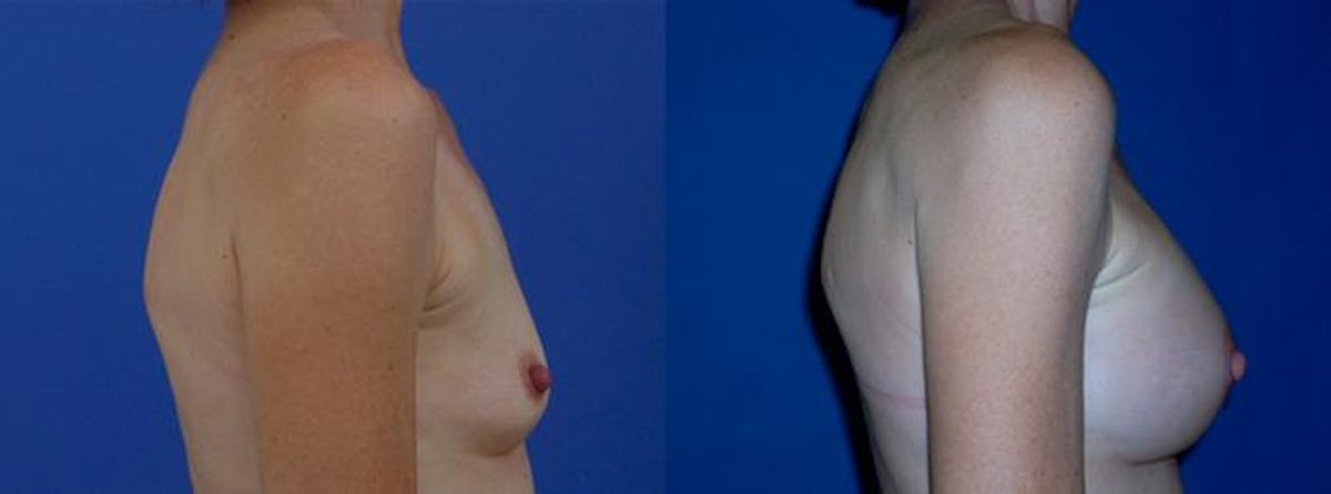 Breast Augmentation Before & After Gallery - Patient 251308 - Image 2