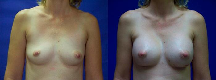 Hidden Breast Aug Before & After Gallery - Patient 155151 - Image 1