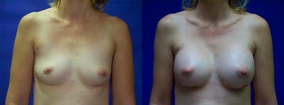 Breast Augmentation Before & After Gallery - Patient 122405432 - Image 1