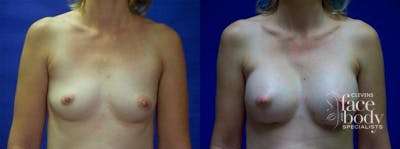 Hidden Breast Aug Before & After Gallery - Patient 155151 - Image 1