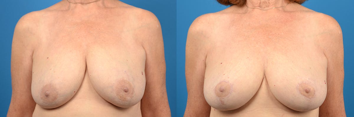 Breast Lift Before & After Gallery - Patient 858038 - Image 1