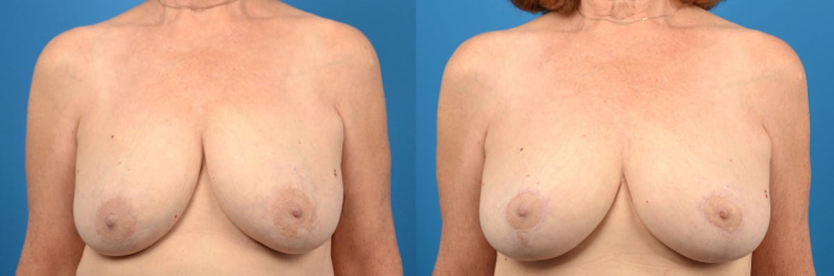 Hidden Breast Lift Before & After Gallery - Patient 363543 - Image 1