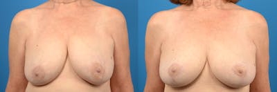 Hidden Breast Lift Before & After Gallery - Patient 324717 - Image 1