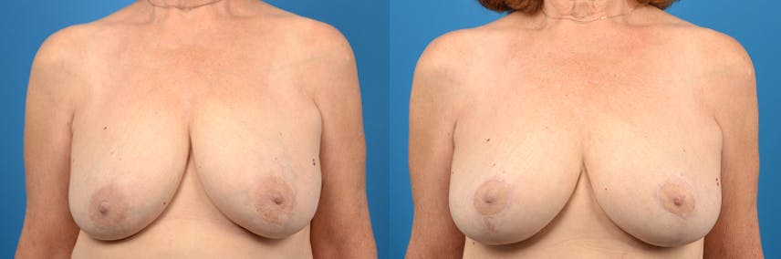 Breast Lift