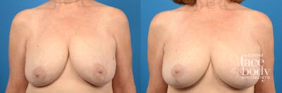 Hidden Breast Lift Before & After Gallery - Patient 324717 - Image 1