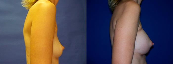 Hidden Breast Aug Before & After Gallery - Patient 155151 - Image 2