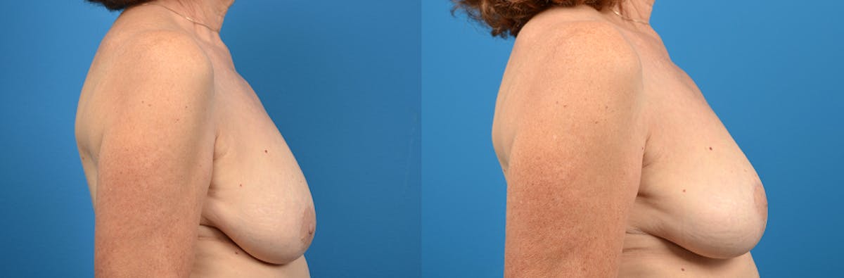 Breast Lift Before & After Gallery - Patient 858038 - Image 2