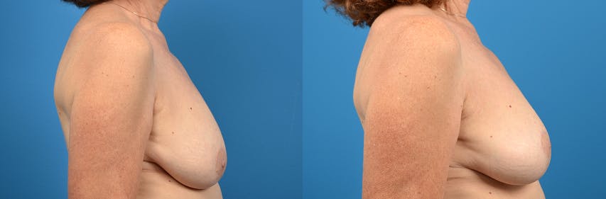 Breast Lift Before & After Gallery - Patient 122405433 - Image 2