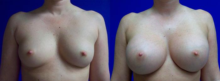 Hidden Breast Aug Before & After Gallery - Patient 325557 - Image 1