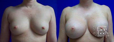 Hidden Breast Aug Before & After Gallery - Patient 325557 - Image 1