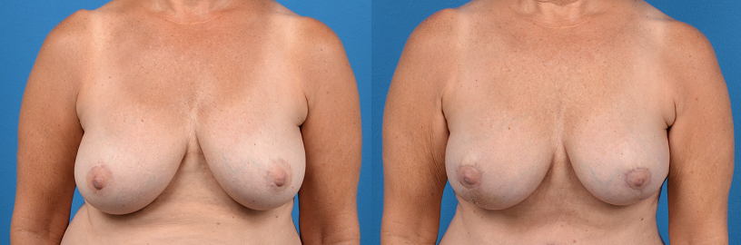 Hidden Breast Lift Before & After Gallery - Patient 130983 - Image 1