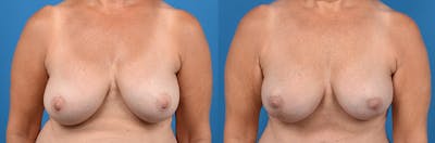 Breast Lift Before & After Gallery - Patient 134435 - Image 1
