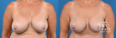Hidden Breast Lift Before & After Gallery - Patient 130983 - Image 1