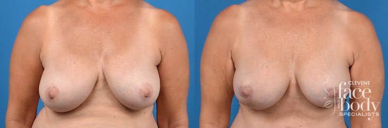 Hidden Breast Lift Before & After Gallery - Patient 122796 - Image 1