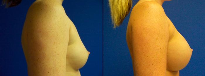 Hidden Breast Aug Before & After Gallery - Patient 325557 - Image 2