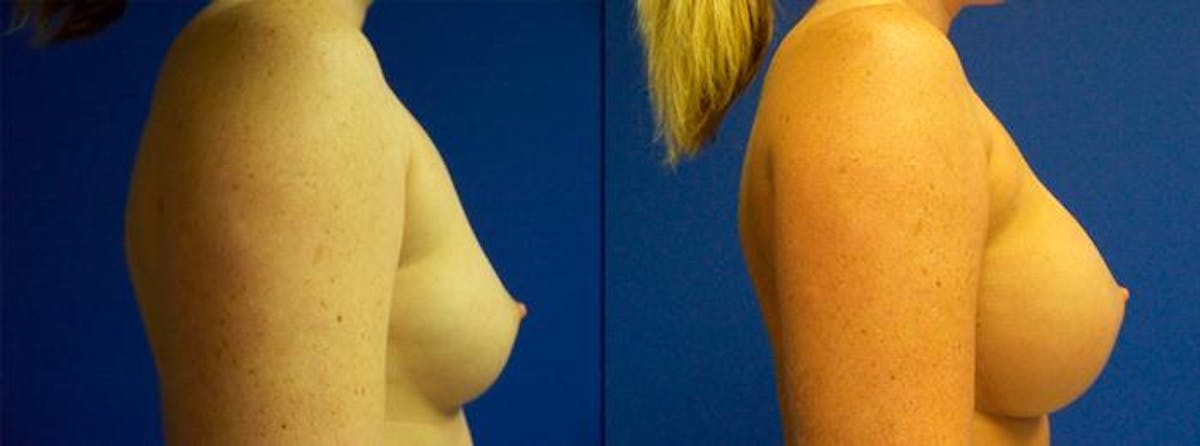 Breast Augmentation Before & After Gallery - Patient 357547 - Image 2