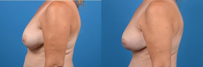 Hidden Breast Lift Before & After Gallery - Patient 130983 - Image 2