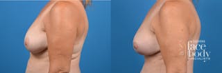 Hidden Breast Lift Before & After Gallery - Patient 122796 - Image 2
