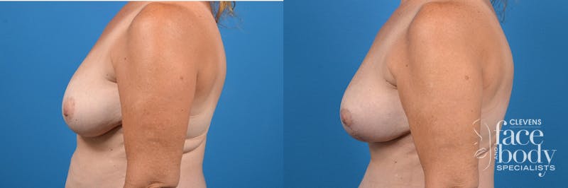 Hidden Breast Lift Before & After Gallery - Patient 122796 - Image 2