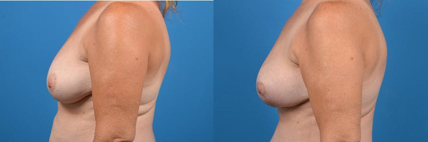 Breast Lift Before & After Gallery - Patient 122405436 - Image 2
