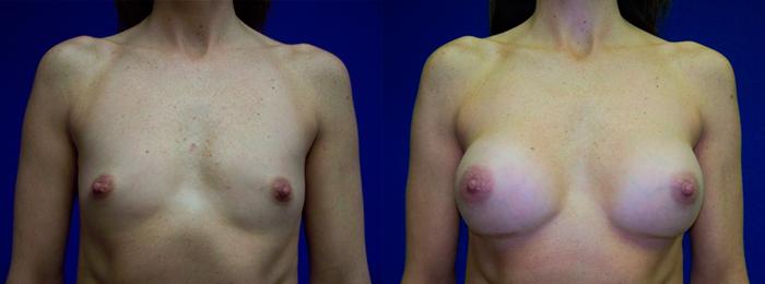 Hidden Breast Aug Before & After Gallery - Patient 216845 - Image 1