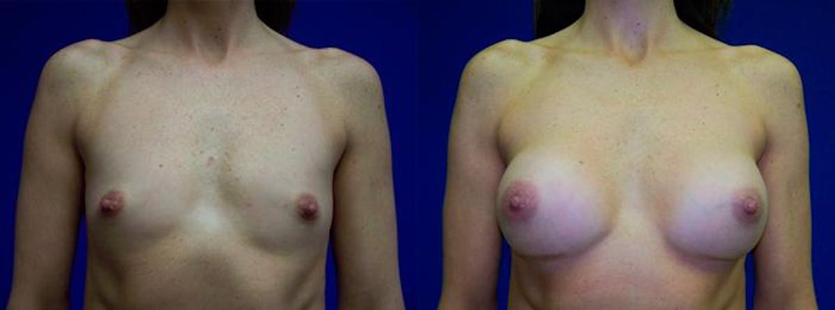Breast Augmentation Before & After Gallery - Patient 122405435 - Image 1
