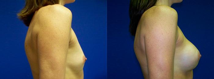 Hidden Breast Aug Before & After Gallery - Patient 216845 - Image 2