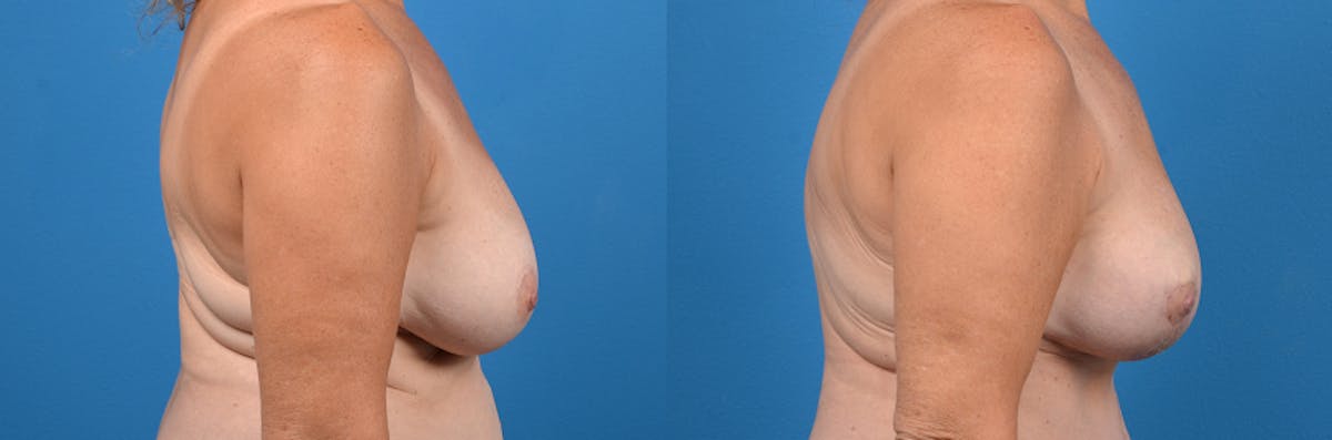 Hidden Breast Lift Before & After Gallery - Patient 122796 - Image 3
