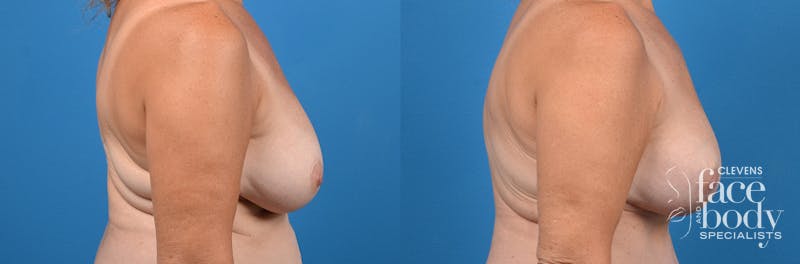 Hidden Breast Lift Before & After Gallery - Patient 122796 - Image 3