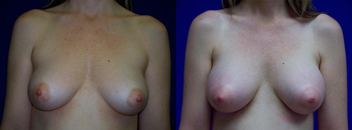 Hidden Breast Aug Before & After Gallery - Patient 125343 - Image 1