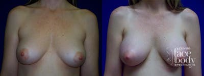 Hidden Breast Aug Before & After Gallery - Patient 125343 - Image 1