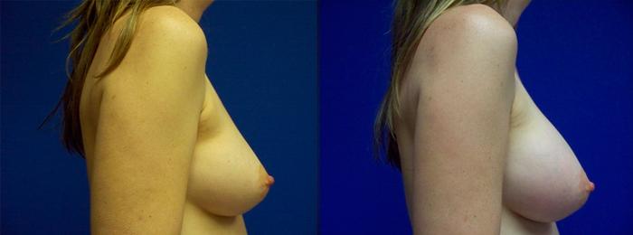 Hidden Breast Aug Before & After Gallery - Patient 125343 - Image 2