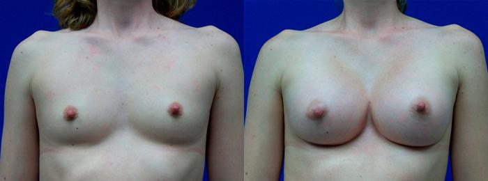 Hidden Breast Aug Before & After Gallery - Patient 153688 - Image 1