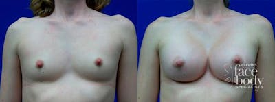 Hidden Breast Aug Before & After Gallery - Patient 153688 - Image 1